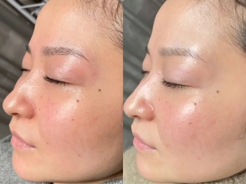 毛穴洗浄 ワックス脱毛の掲載