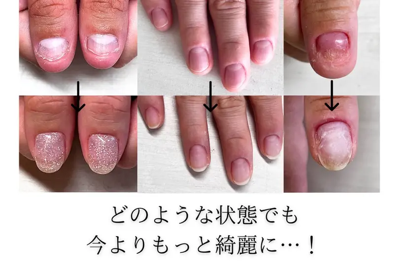 深爪矯正・自爪育成 ヴェールリムの掲載