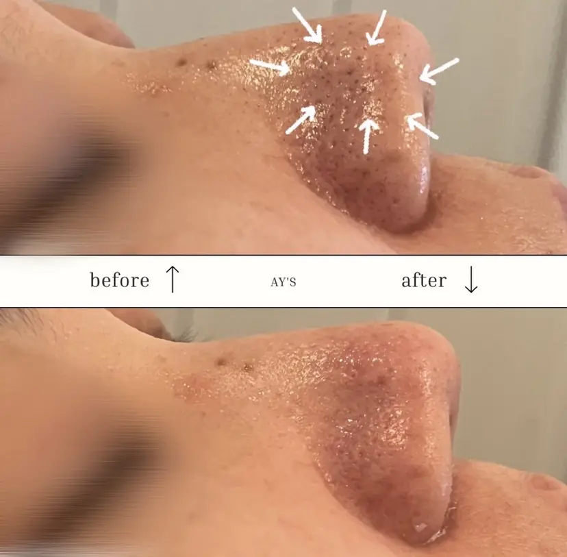 倉敷/玉島/20代 からの大人毛穴洗浄の掲載