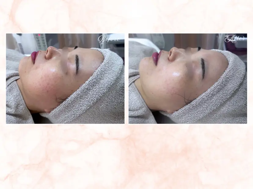 |ピーリング・毛穴| soina神楽坂の掲載