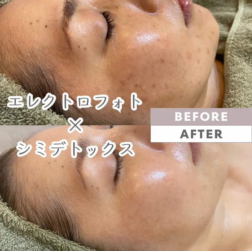 脱毛｜ピーリング ROOM.Sの掲載