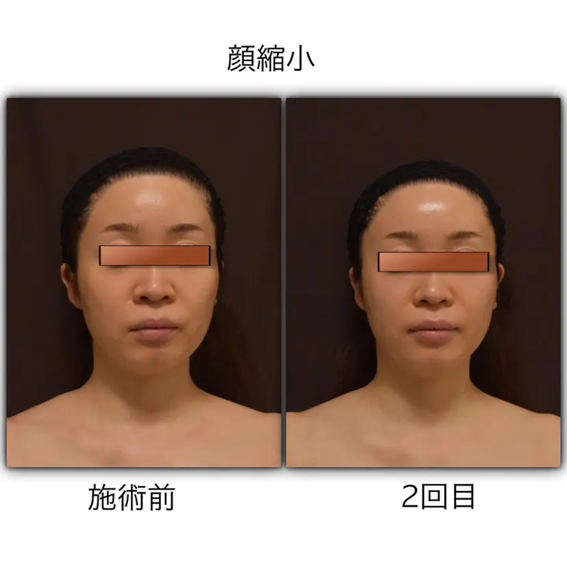 韓国式小顔矯正 担当ゆいの掲載