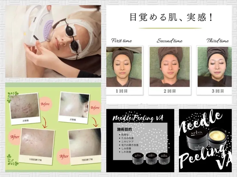 脱毛＆肌質改善サロン shandeelの掲載