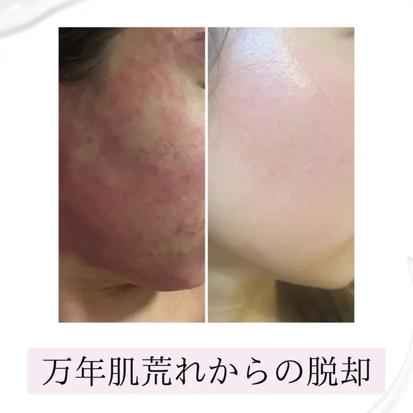 四つ星サロン🎖 腸&ニキビケアに特化の掲載