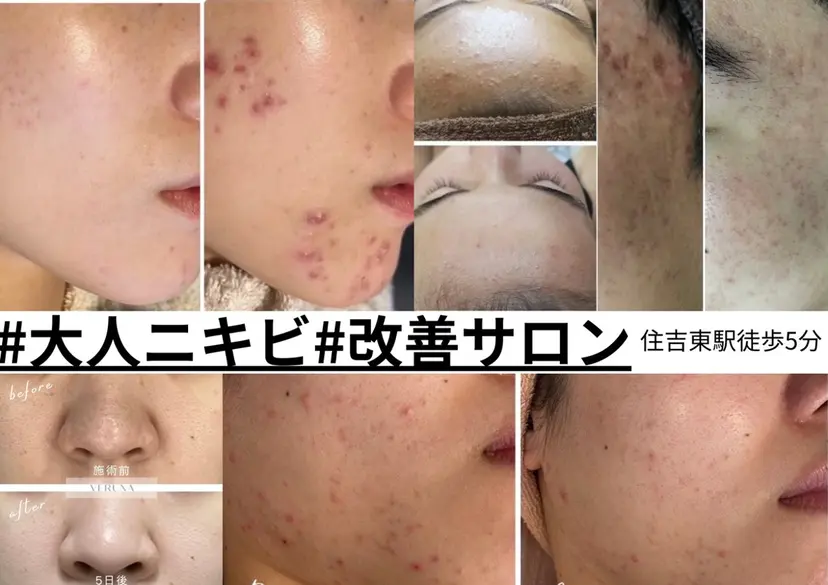 ニキビ改善専門店 d'Albaの掲載