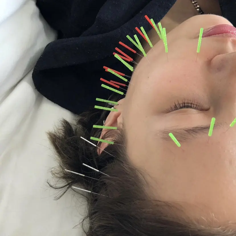 美容鍼♡小顔矯正♡ fumikaの掲載