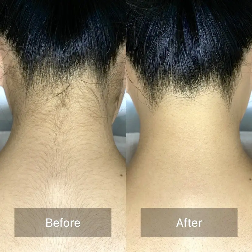 港区都度払い脱毛 miranjuの掲載