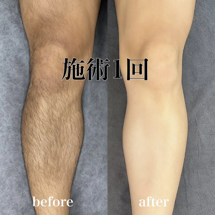 銀座ワックス脱毛 メンズ脚の掲載