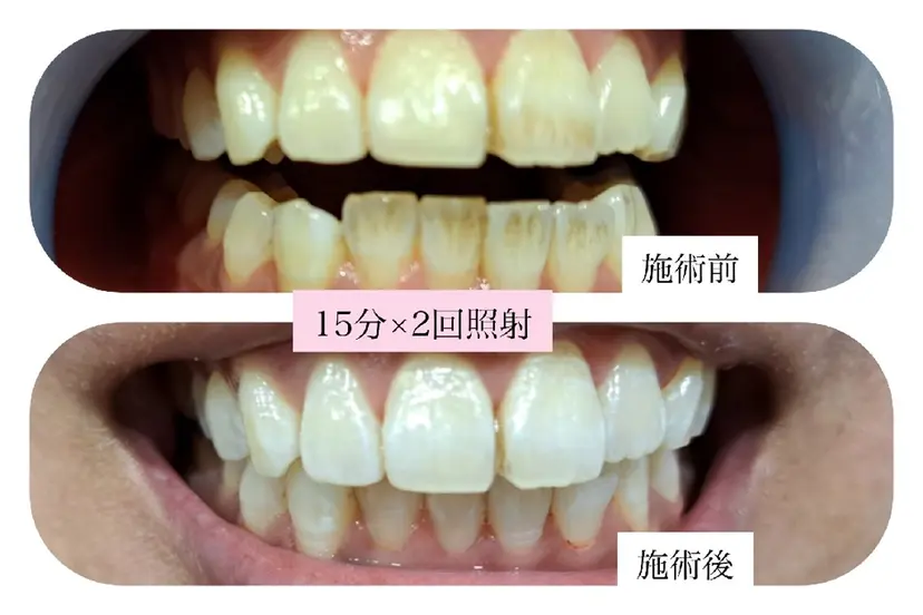 美肌脱毛サロン つるりとの掲載