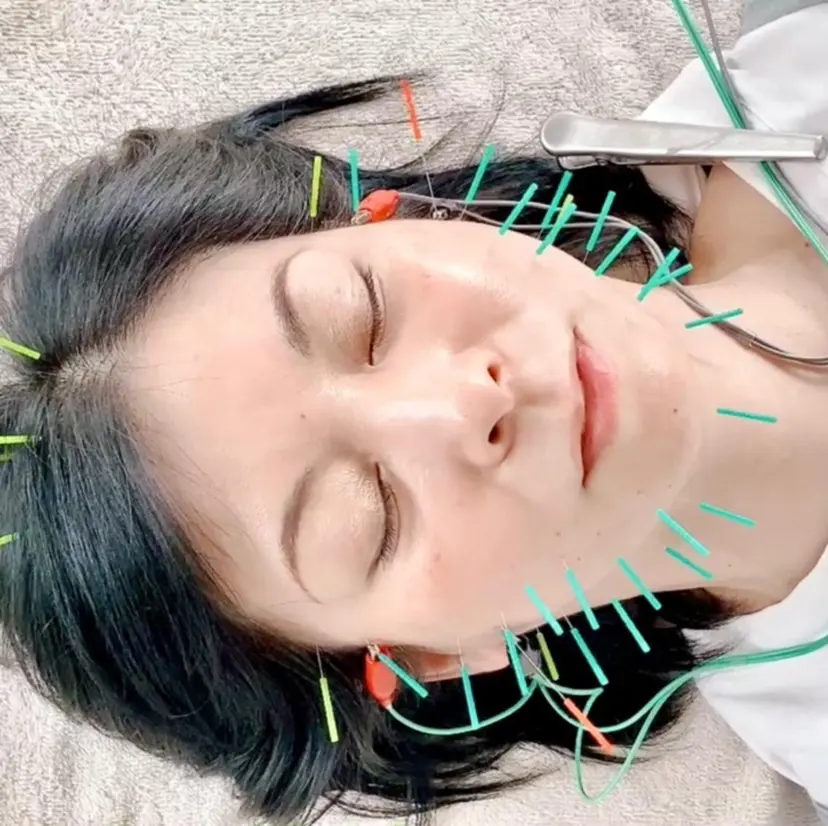 筋膜リリース 小顔美容鍼の掲載
