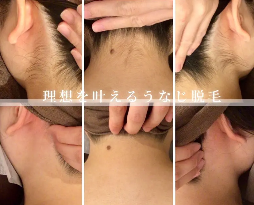美肌特化の イオン導入脱毛の掲載
