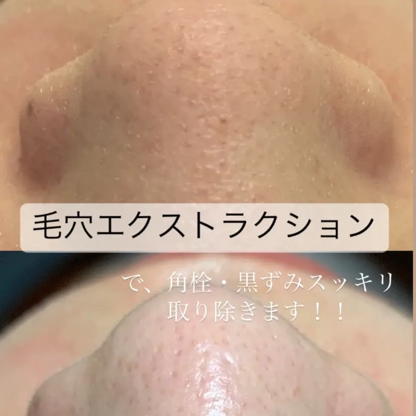 【天神】毛穴・インデ ィバ・ボディケアの掲載