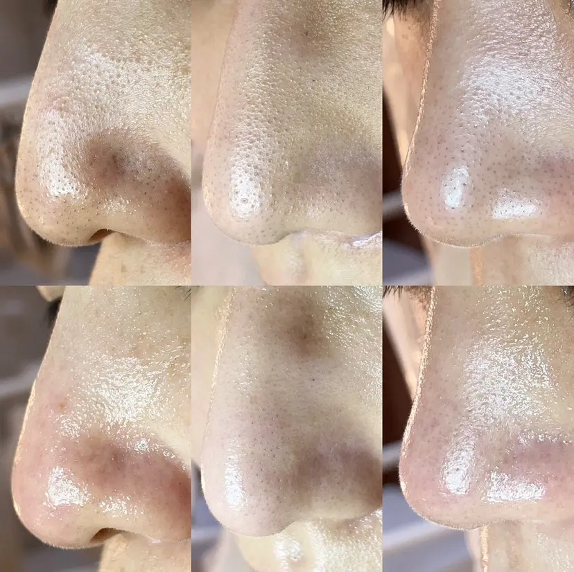 毛穴専門店👃 毛穴汚れごっそり✨の掲載