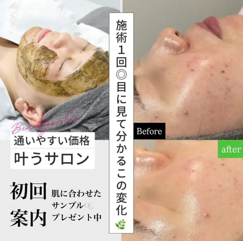 ele" ＼ハーブで肌質改善／の掲載