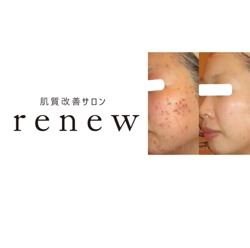 肌質改善サロン renew/ｳｴｷの掲載
