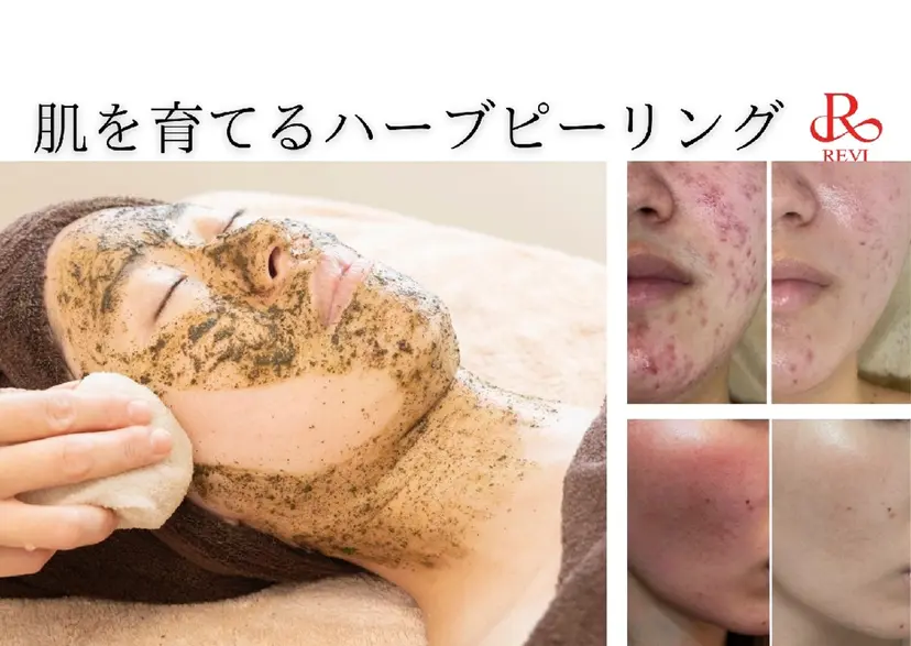 本気の肌質改善/ ハーブピーリングの掲載
