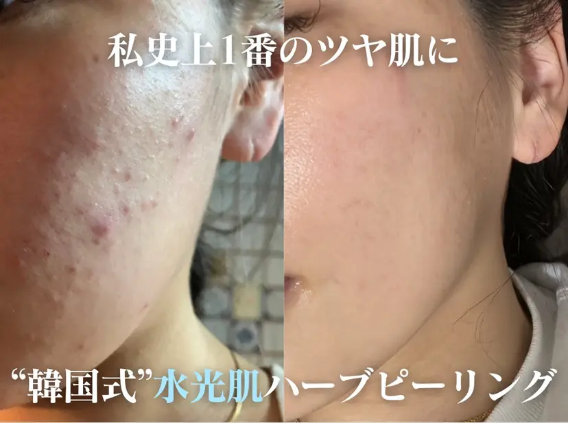 ニキビ・ニキビ跡改善 HIMEKAの掲載