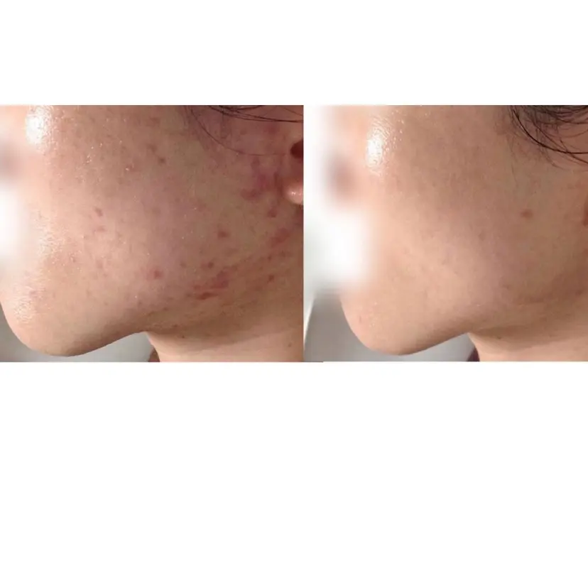 都度払い肌質改善 &脱毛Blancheの掲載