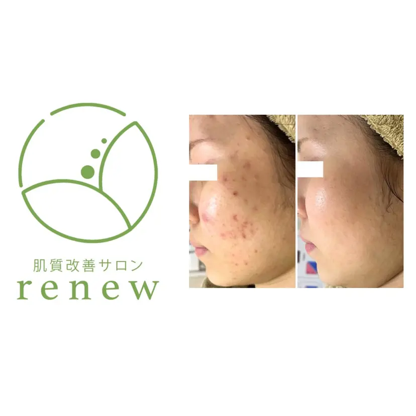 肌質改善サロン renew/ウエキの掲載