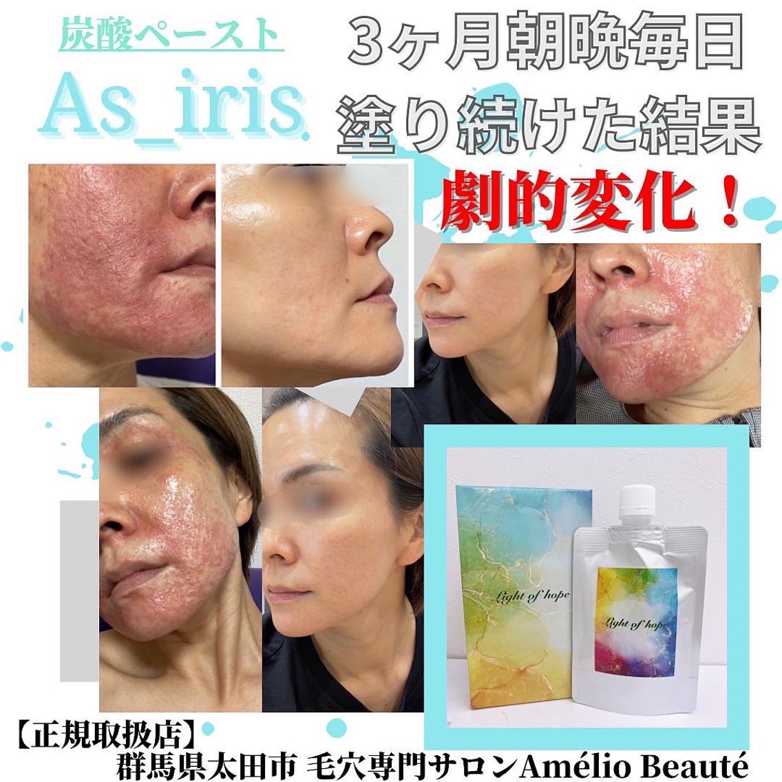 アズイリス　炭酸ペースト アズイリス 【As_iris】 炭酸ガスペーストパック 経皮吸収剤