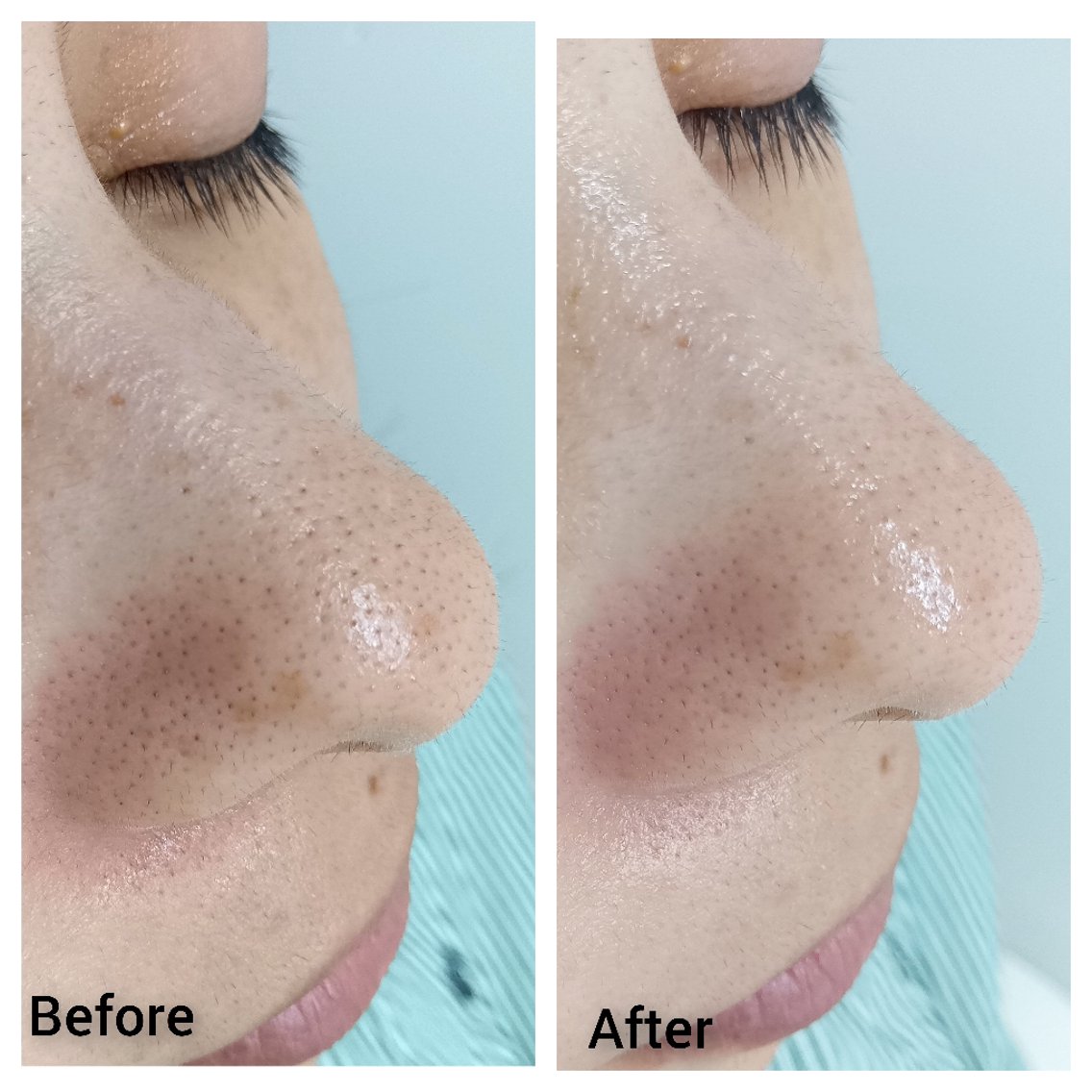 低周波でシミを排出していきます 痛みはほとんどありません