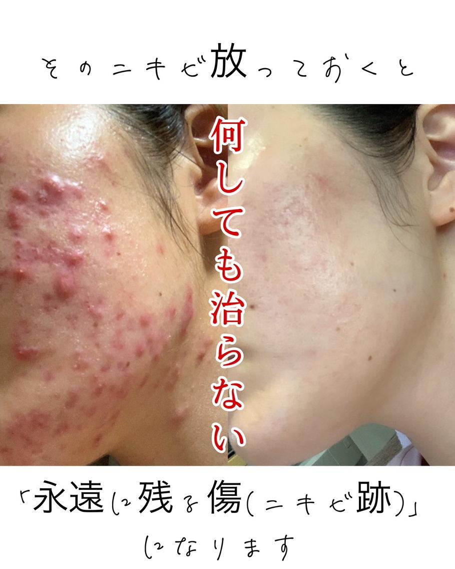 美ラボさん専用　剥離ありハーブピーリング50回分 エステ・リラクフォトカタログ「剥離ありハーブピーリング」byM LABO