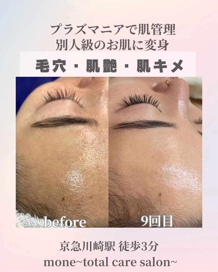 プラズマ　 エステ Elegram新メニュー🩷✨ 繰り返すニキビ・肌荒れ・シミに肌質から整える