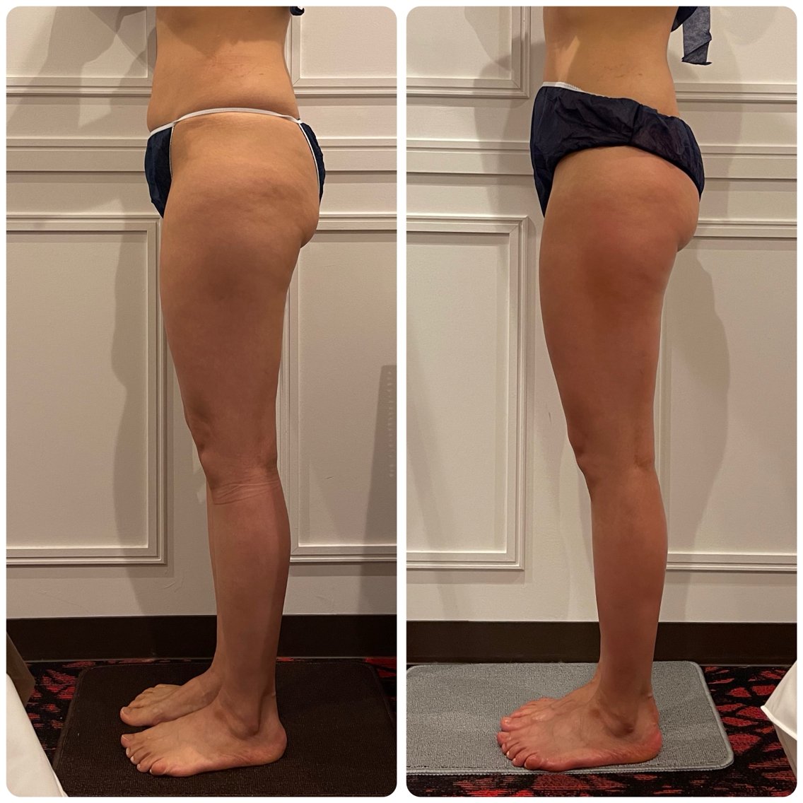 長堀橋駅近くでセルライト除去のおすすめエステ・リラク＆人気