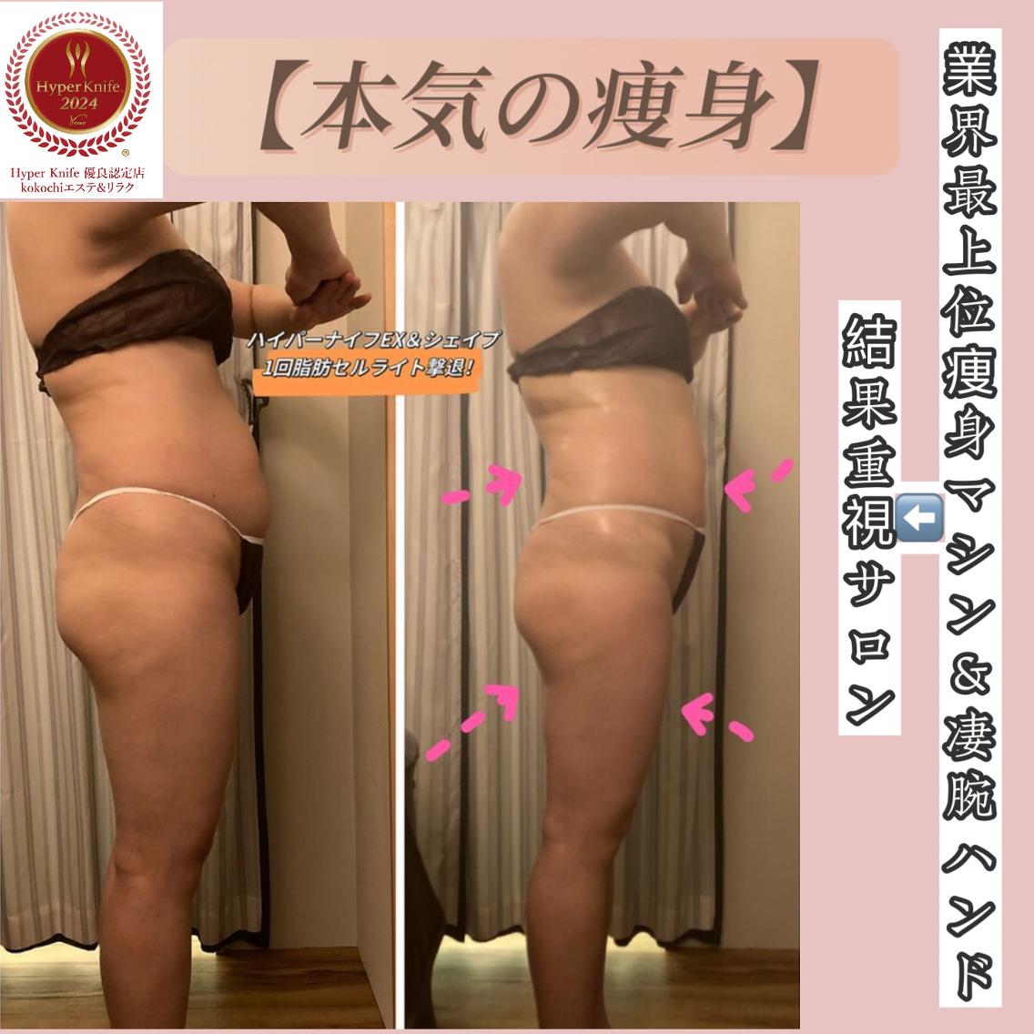 東京都でセルライト除去のおすすめエステ・リラク＆人気