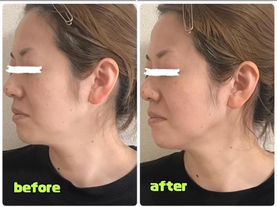 美顔器によってのビフォーアフターです フェイスラインがスッキリ｜鍵