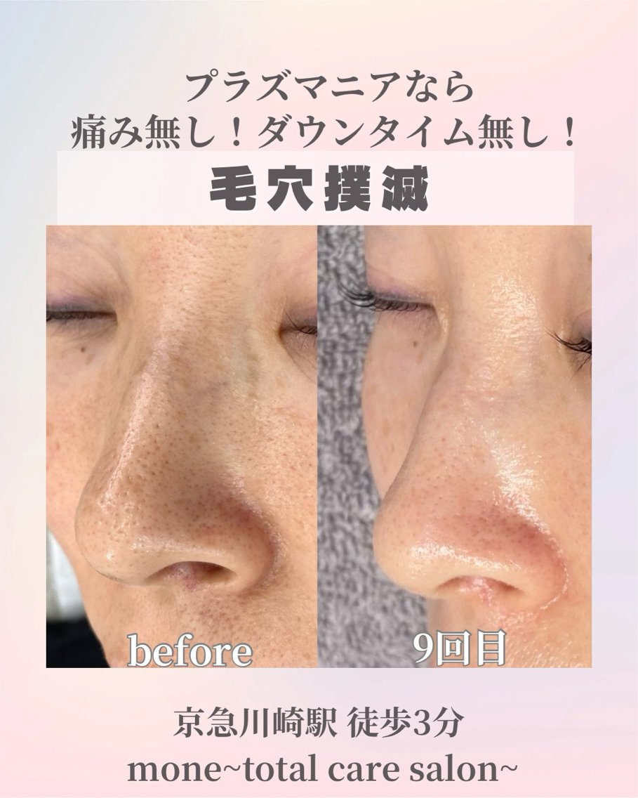 プラズマニア】【痛み・ダウンタイム無し】肝斑・くすみ・毛穴の