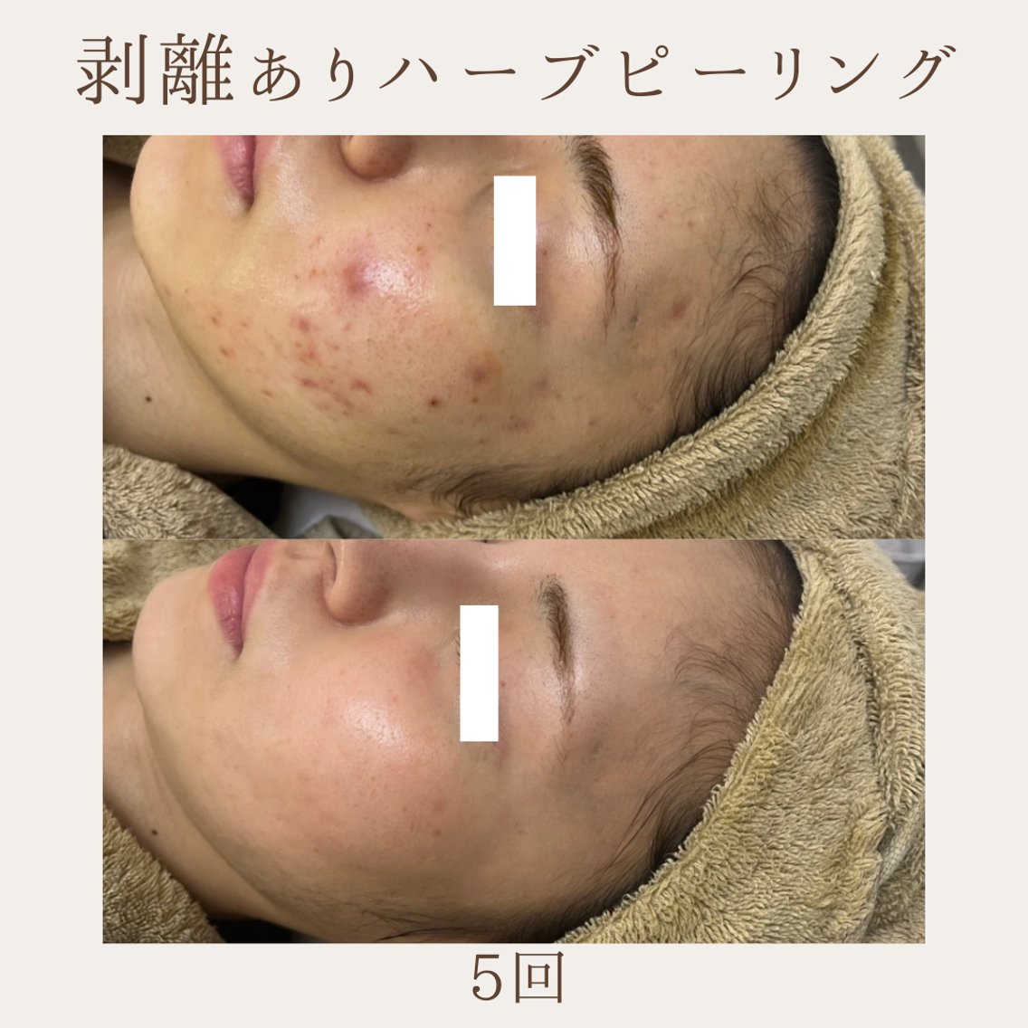 肌質改善サロン renew所属・肌質改善サロン renew/ｳｴｷのエステ