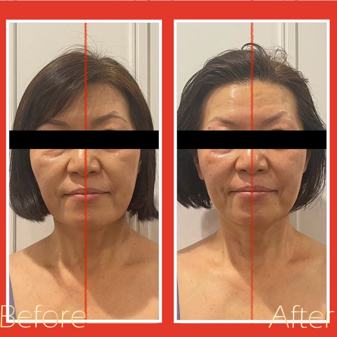 優良認定店でしか施術が受けられない「ハイパーナイフEX」 皮下7〜8