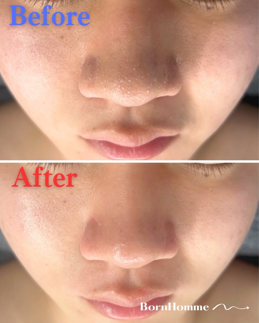 心斎橋駅近くで毛穴洗浄のおすすめエステ・リラク＆人気