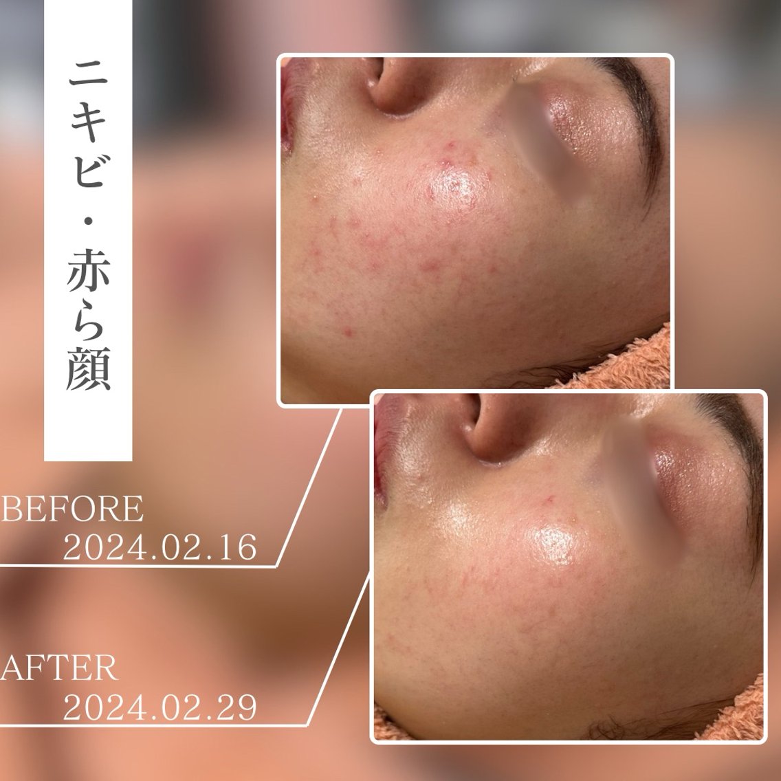 ✨️低周波顔シミ取りエステ✨️人気商品✨️即日発送 5e6a9c4088023a1dba8cc6f4f82d4d