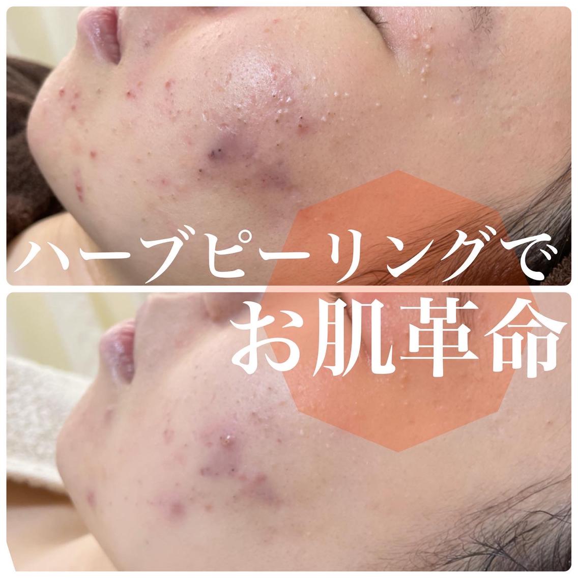ニキビ・毛穴改善 ハーブピーリング(self-caresalon1/fゆらぎ所属)の