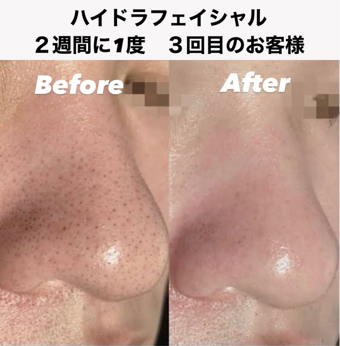 毛穴洗浄（ハイドラフェイシャル）は2週間に1度の頻度でご来店