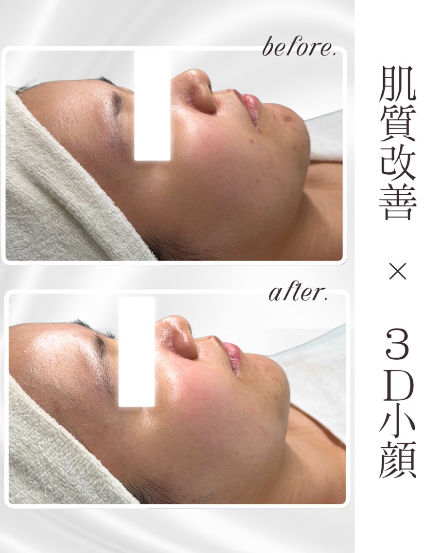 ROOレモンボトル　最新ララピール ☆ 【NEW】脂肪溶解美容液レモンボトル🍋 導入してから多くの