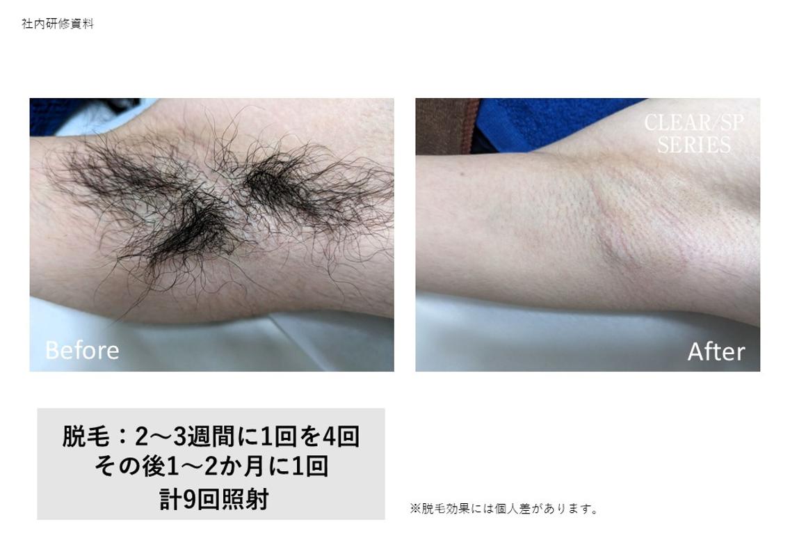 エステ・リラクフォトカタログ「プラズマシャワーの革新的な技術