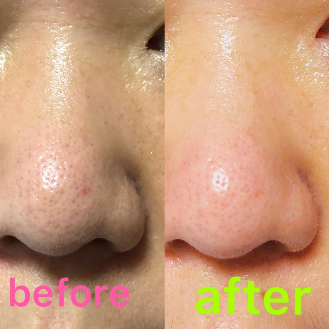 50 メンズ 鼻 黒ずみ ファッションのすべて