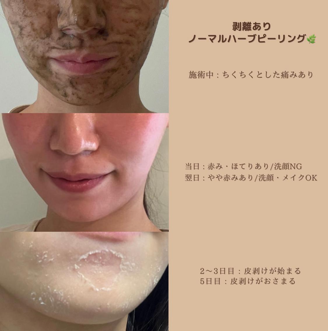 ハーブピーリング 剥離あり 皮向けあり 10回分→10g c3f81ff1cf9ba462df0afa219d57d2
