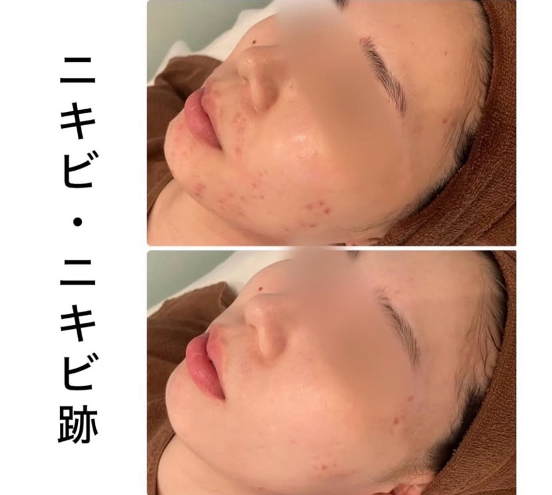 リベルハーブピーリング セット ハーブピーリング lv7_card.jpg?fitin=272:272