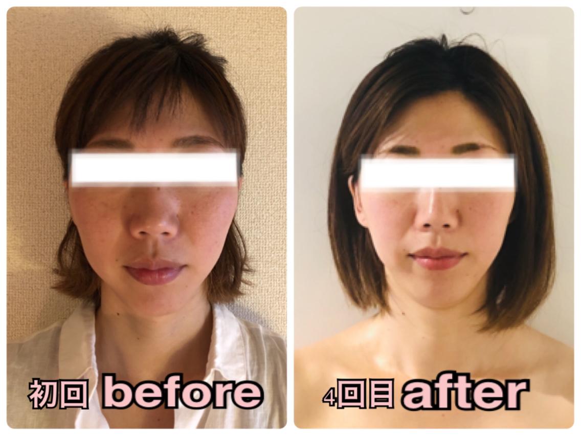 回数を重ねると 更にいい状態がアップし長持ちして頂いてます 小顔