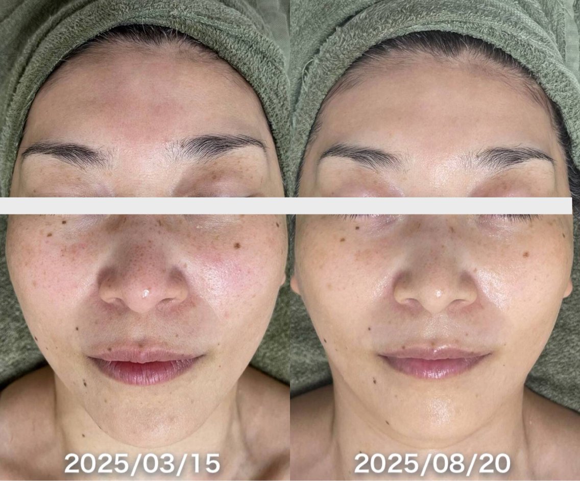 リブセラのプラズマ機器導入店️プラズマで黒ずみを分解して弾き飛ばし