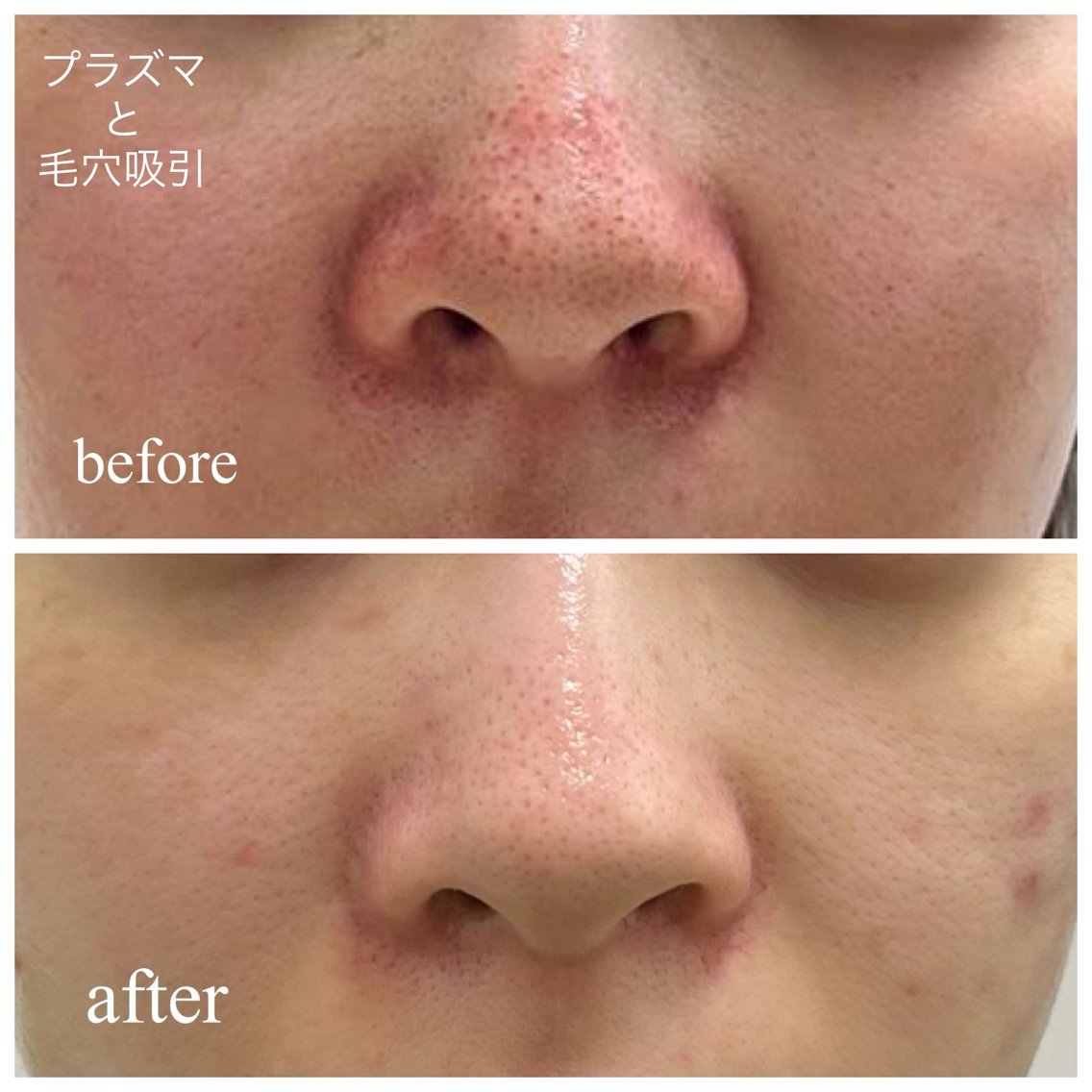 リブセラのプラズマ機器導入店️プラズマで黒ずみを分解して弾き飛ばし