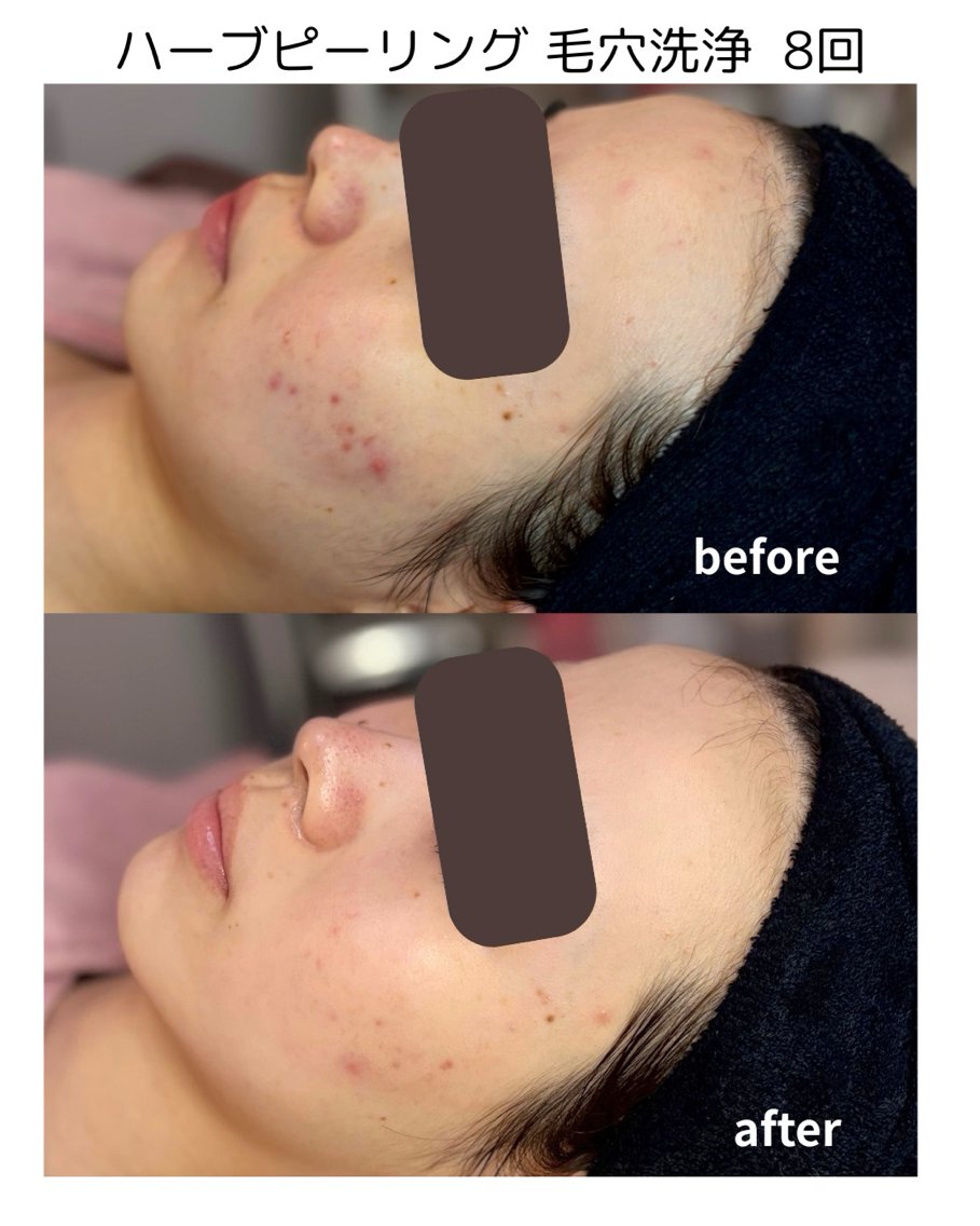 レーザーでは触れない目の周り、まぶたのシミも当店の低周波ペンシルで