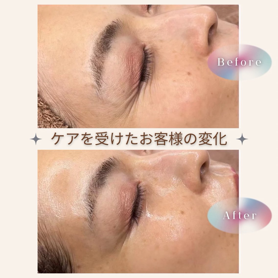 ララピール3回通っていただいた方の変化 1回でも目で見て触ってわかる