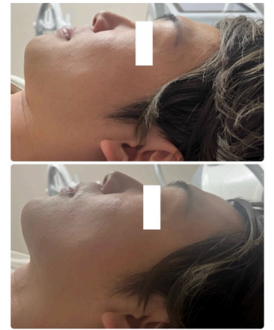 オンダリフト30代男性 1回 マイクロ波により脂肪細胞の減少