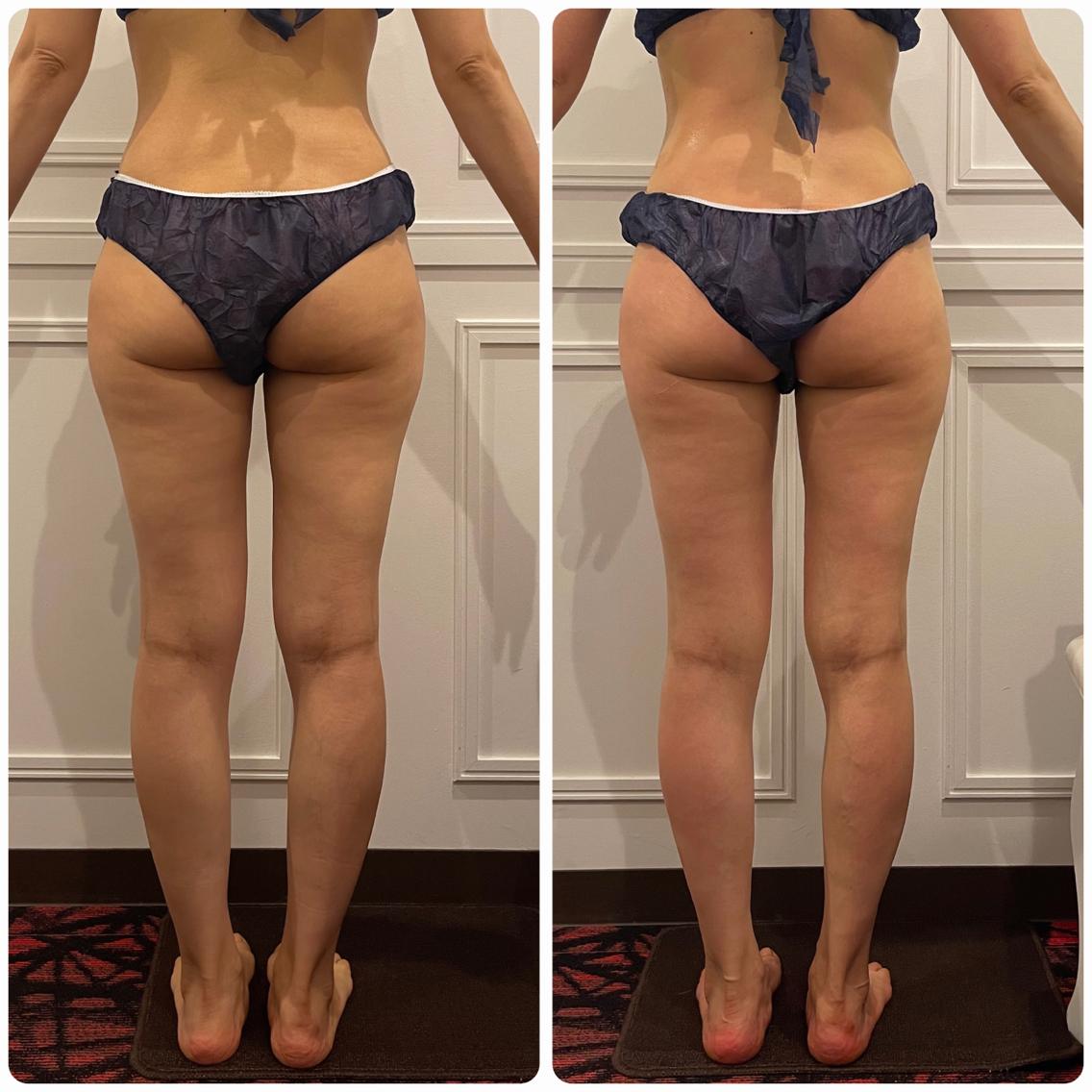 ハイパーシェイプとハイパーナイフ 410606fe83beab041cf7ad1969a9c7