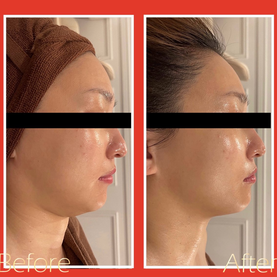 優良認定店でしか施術が受けられない「ハイパーナイフEX」 皮下7〜8